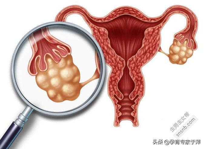 [什么是多囊卵巢综合症]多囊卵巢综合症，是一种什么样的疾病？