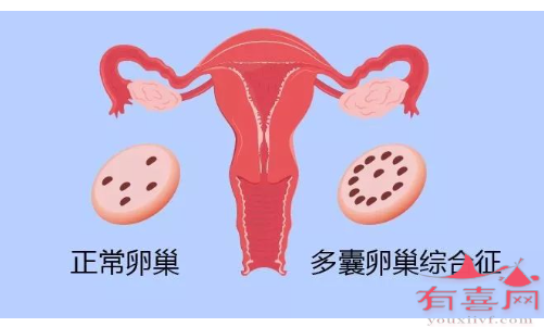 广州广三医院试管婴儿-患有多囊的人自然受孕的几率有多大？